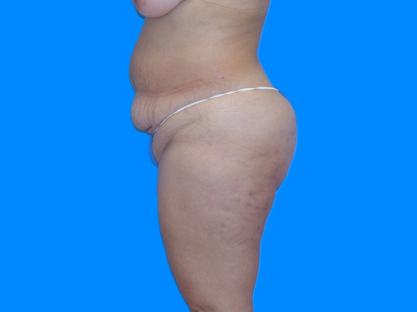 Before Image: Patient Case #1055 - left-side