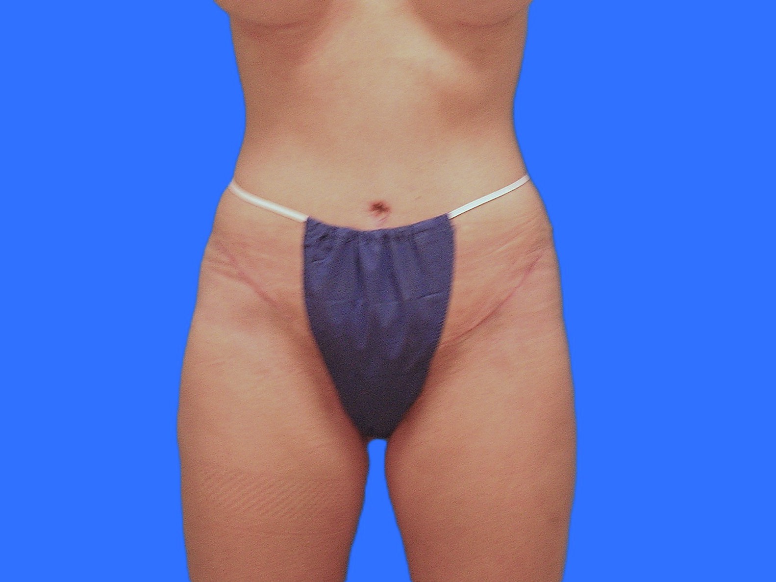 After Image: Patient Case #1057 & 1064 - front