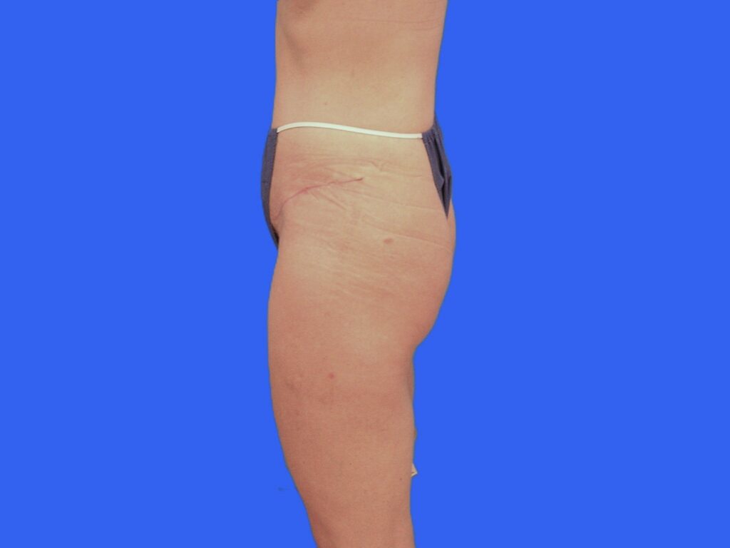 After Image: Patient Case #1057 & 1064 - left-side