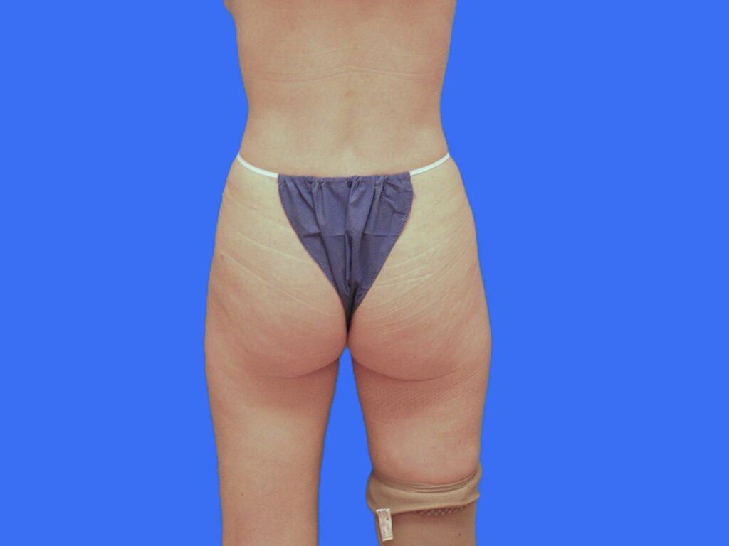 After Image: Patient Case #1057 & 1064 - back