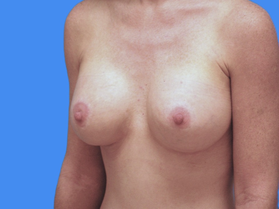 After Image: Patient Case #1057 & 1064 - left-front-oblique