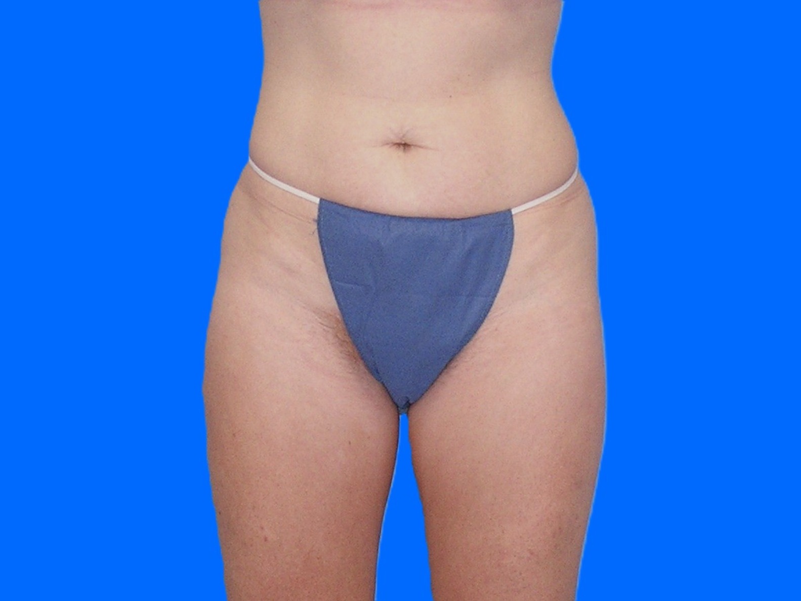 Before Image: Patient Case #1057 & 1064 - front