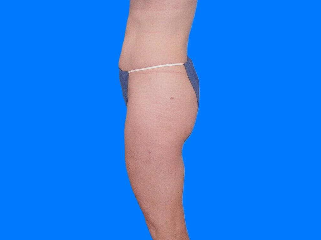 Before Image: Patient Case #1057 & 1064 - left-side