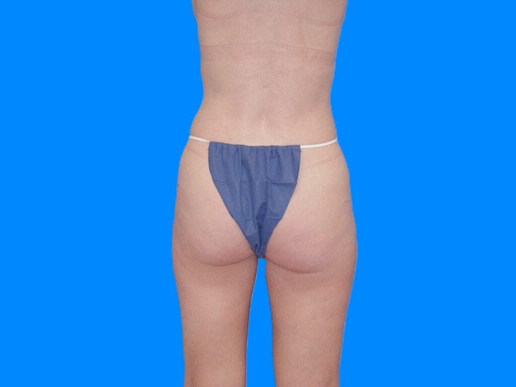 Before Image: Patient Case #1057 & 1064 - back