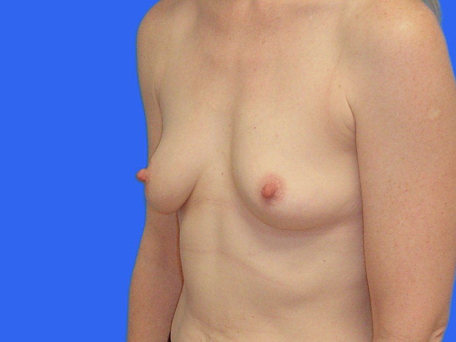 Before Image: Patient Case #1057 & 1064 - left-front-oblique