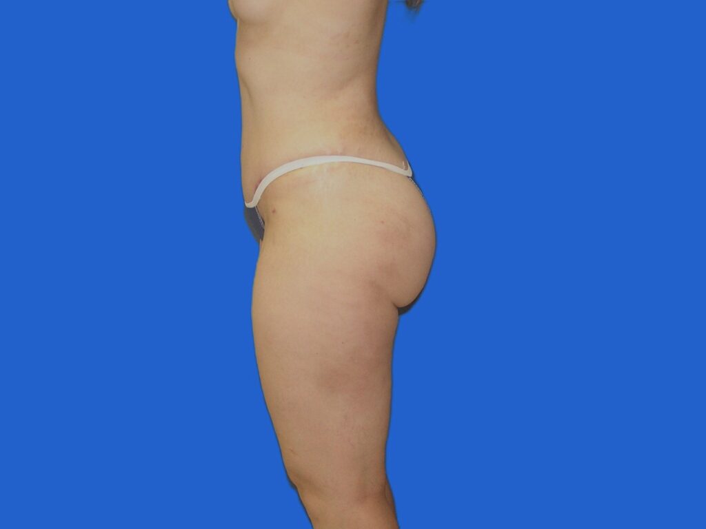 After Image: Patient Case #1058 - left-side