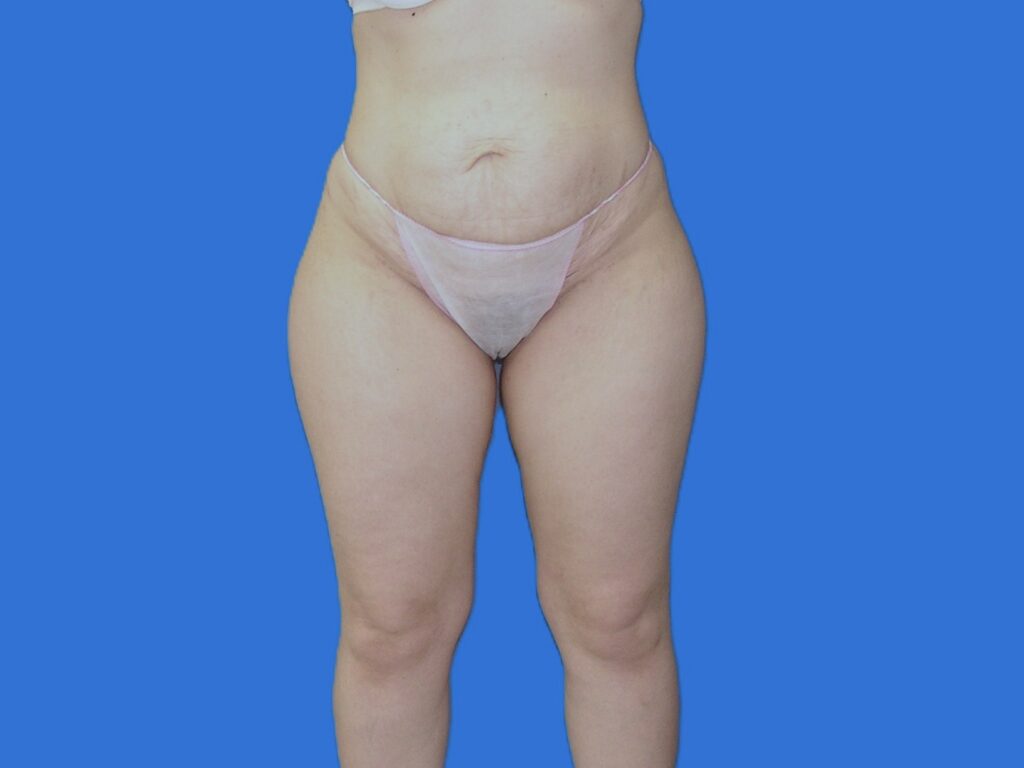 Before Image: Patient Case #1058 - front