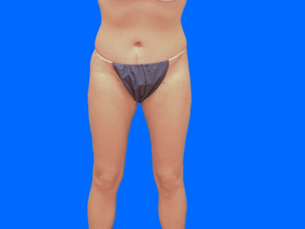 After Image: Patient Case #1059 - front