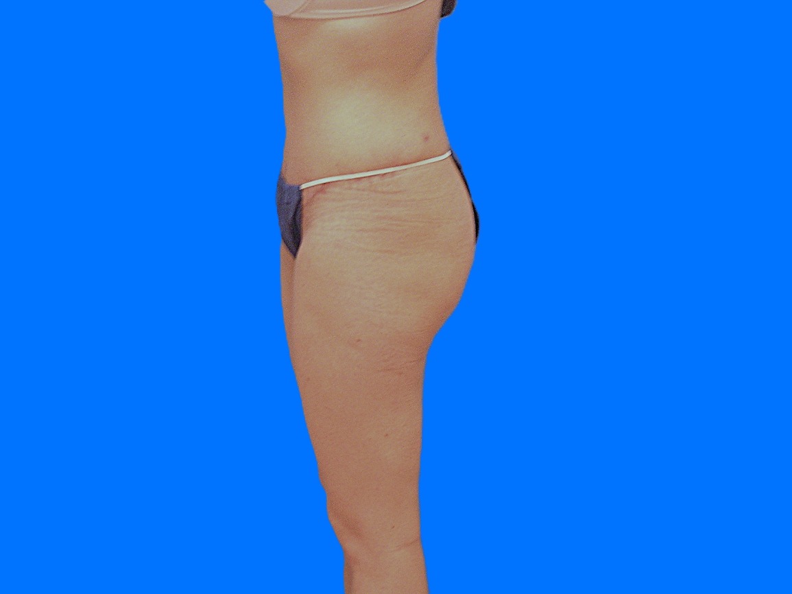 After Image: Patient Case #1059 - left-side