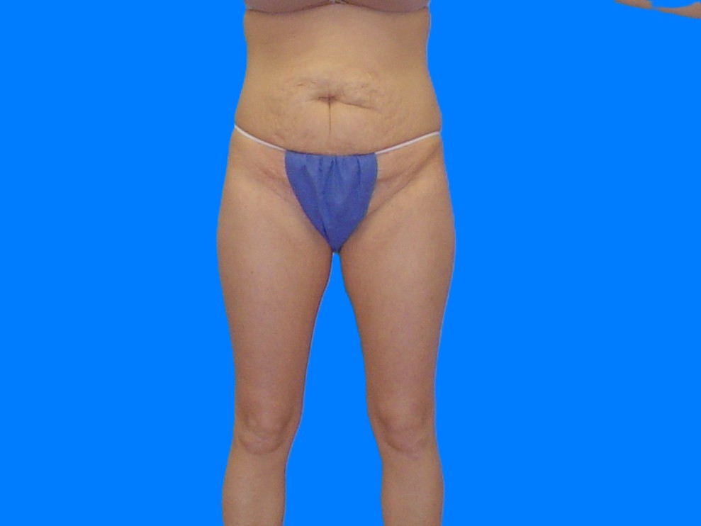 Before Image: Patient Case #1059 - front