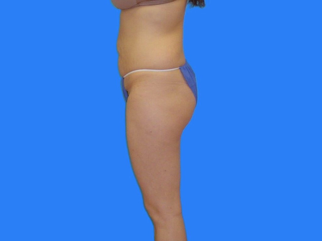 Before Image: Patient Case #1059 - left-side