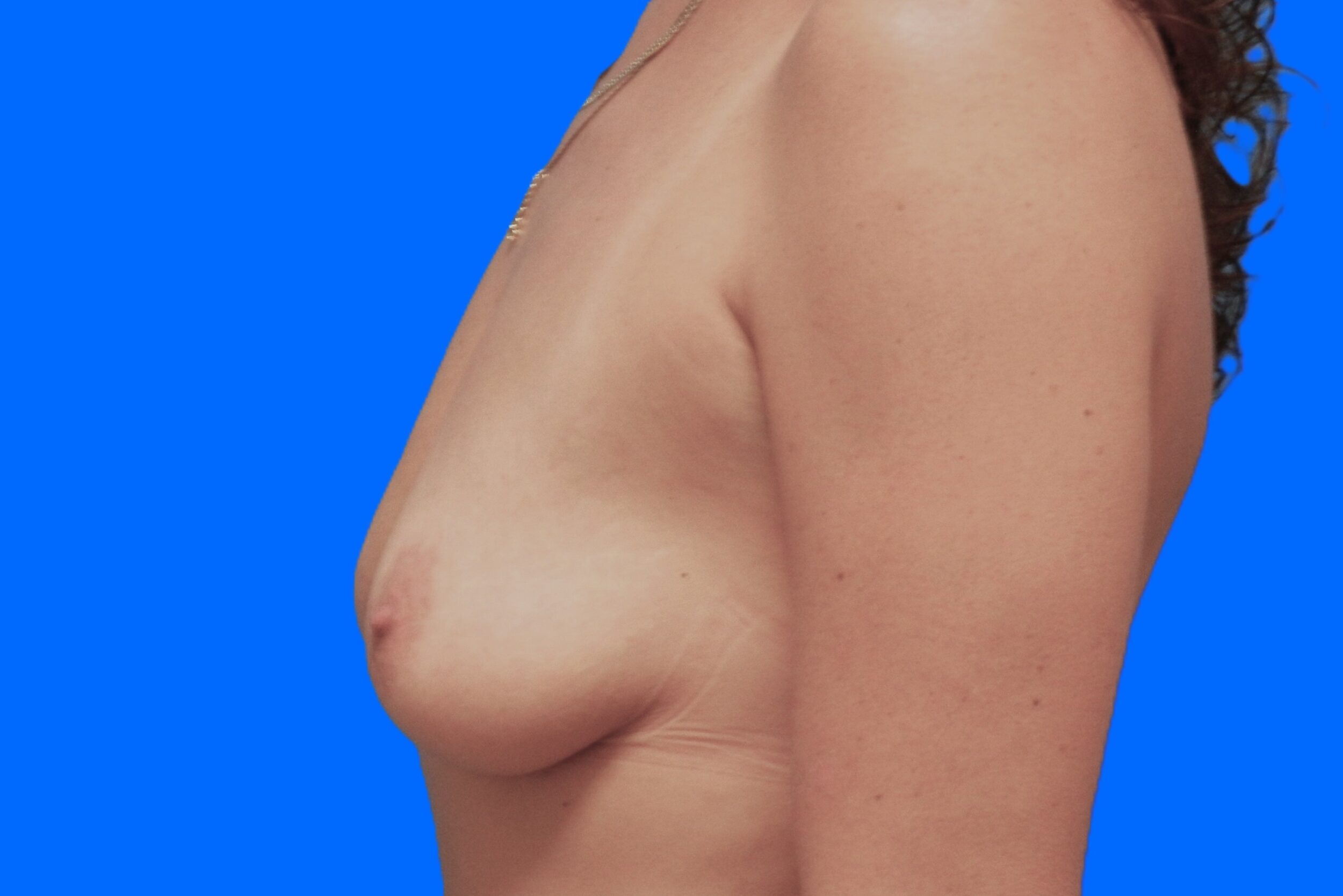 Before Image: Patient Case #1059 - left-side
