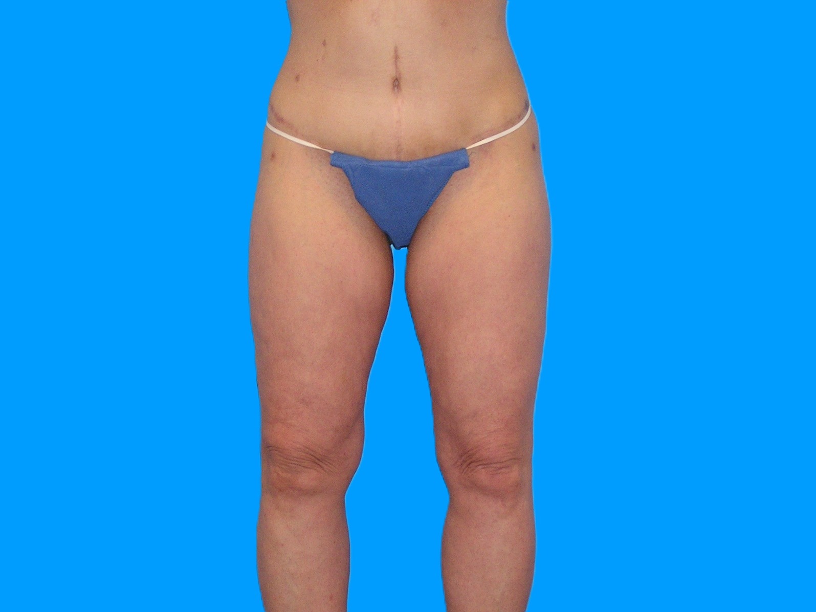 After Image: Patient Case #1063 - front