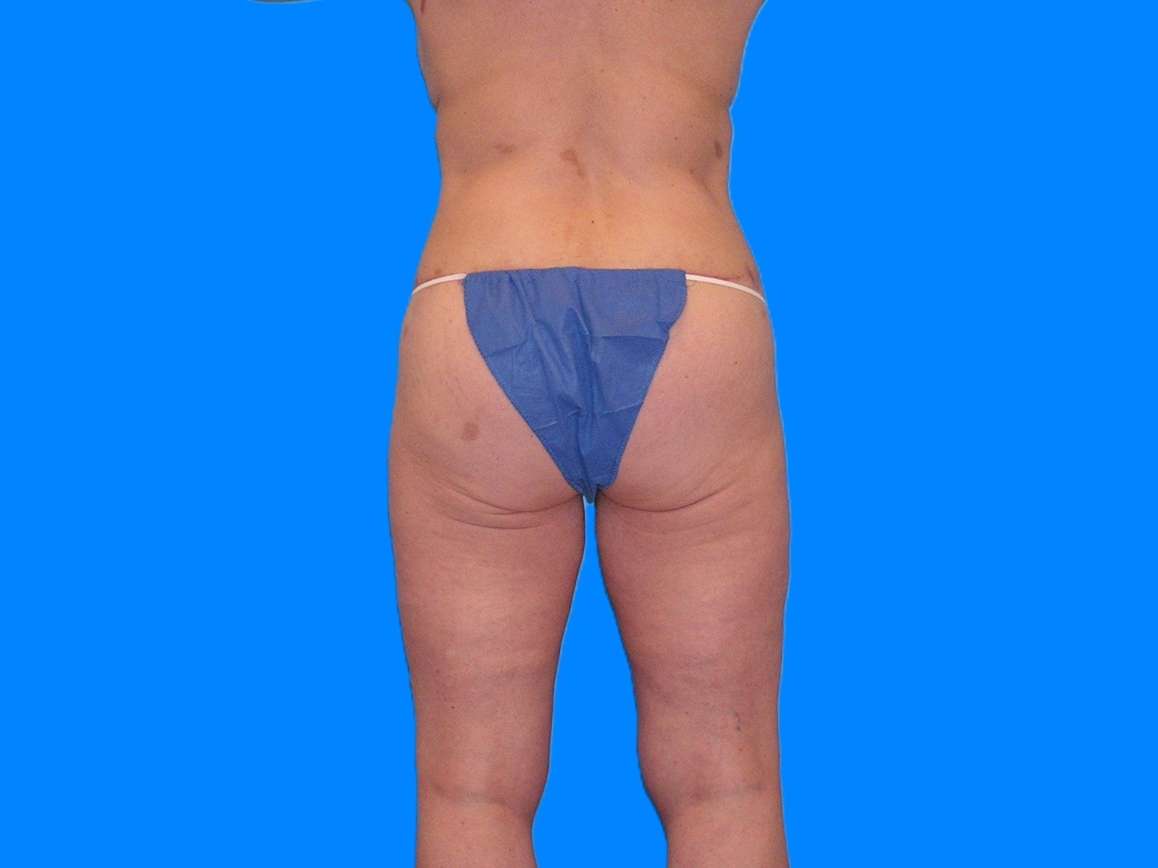 After Image: Patient Case #1063 - back