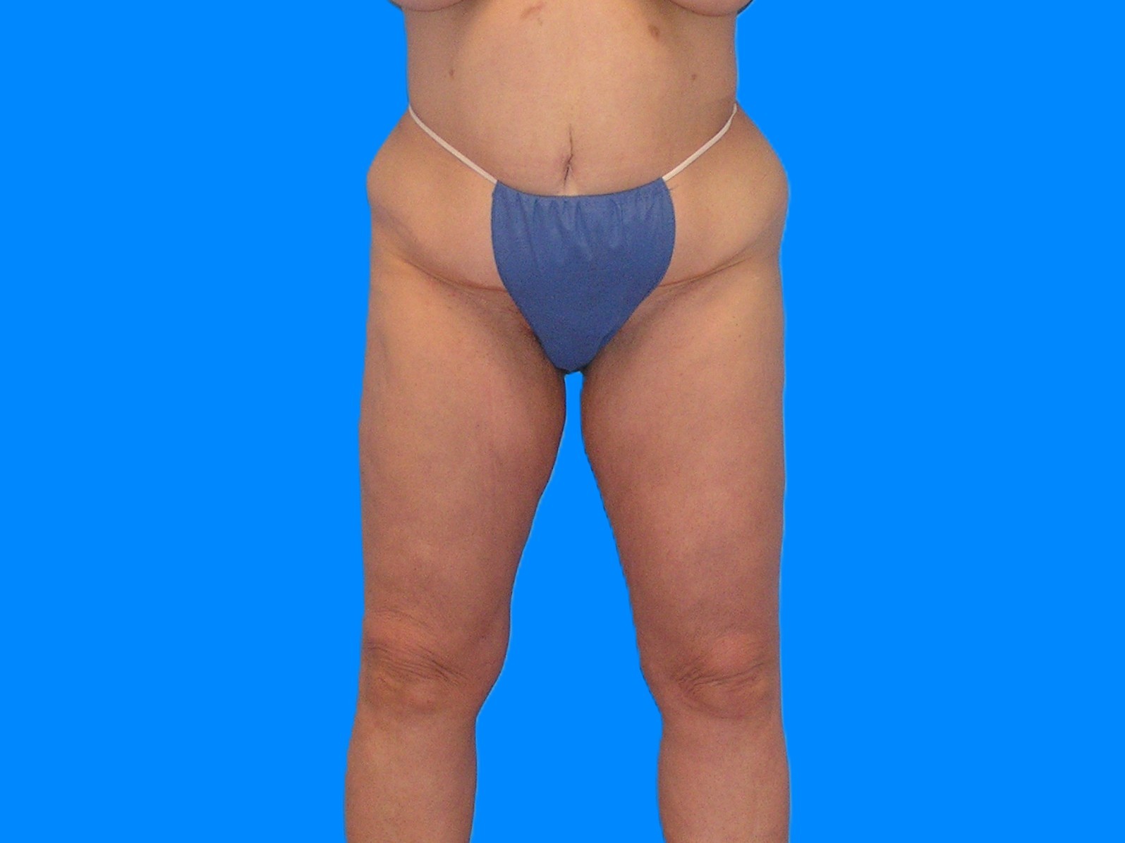 Before Image: Patient Case #1063 - front