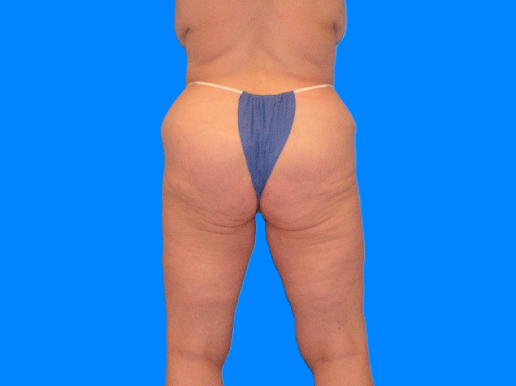 Before Image: Patient Case #1063 - back