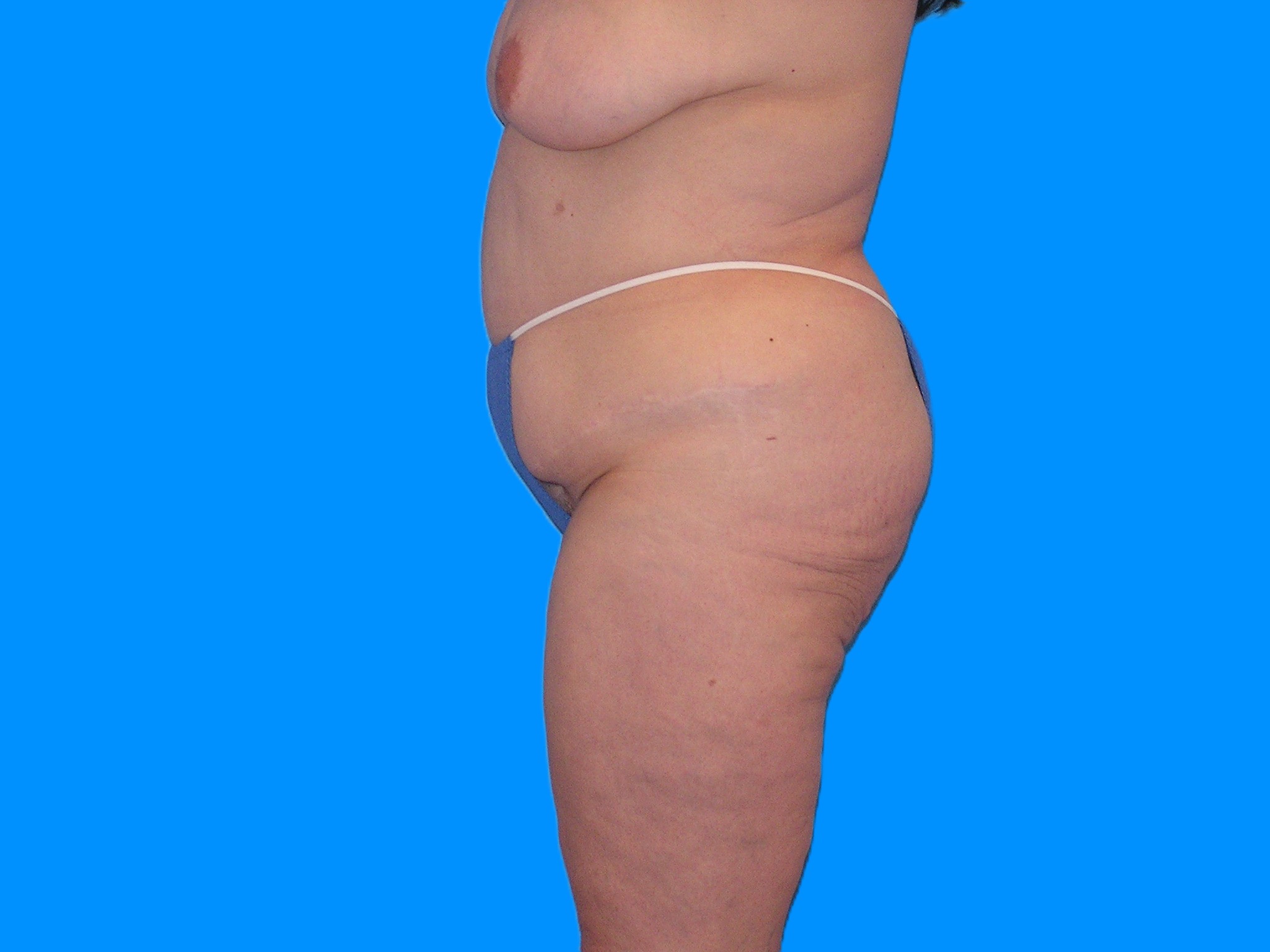 Before Image: Patient Case #1063 - left-side