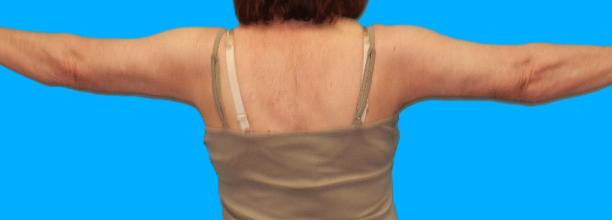 After Image: Patient Case #112 - back