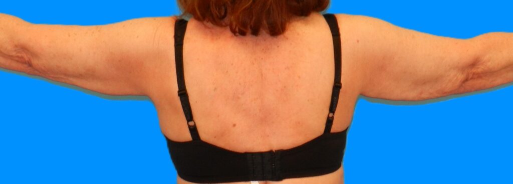 Before Image: Patient Case #112 - back