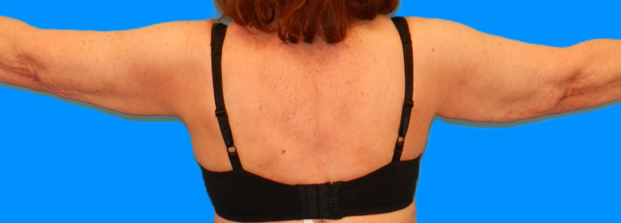 Before Image: Patient Case #112 - back