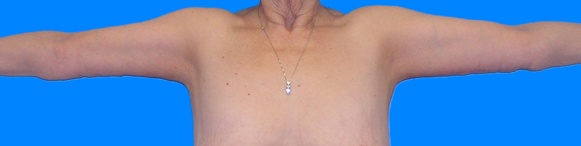 After Image: Patient Case #113 - front