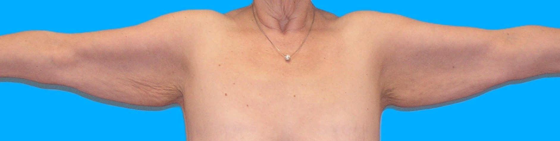 Before Image: Patient Case #113 - front