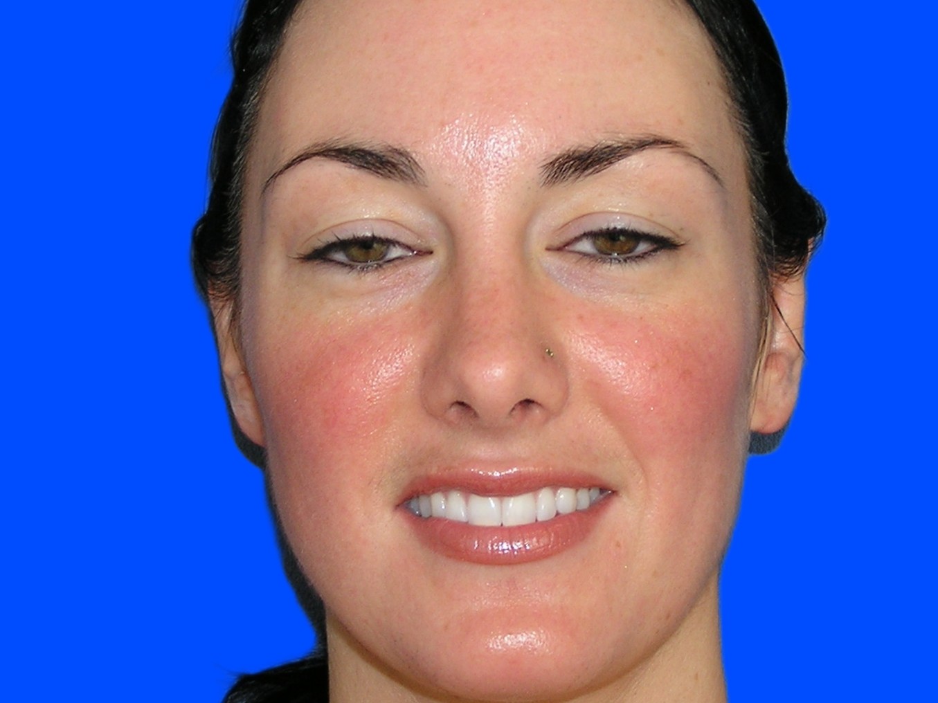 After Image: Patient Case #1137 - front