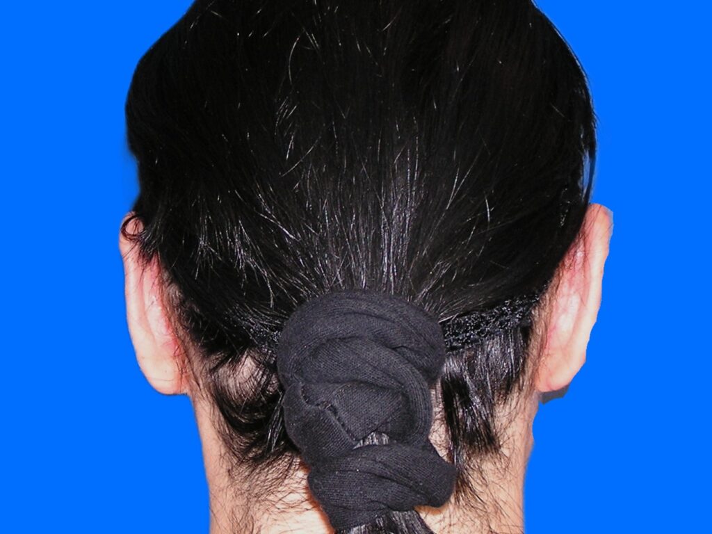 After Image: Patient Case #1137 - back