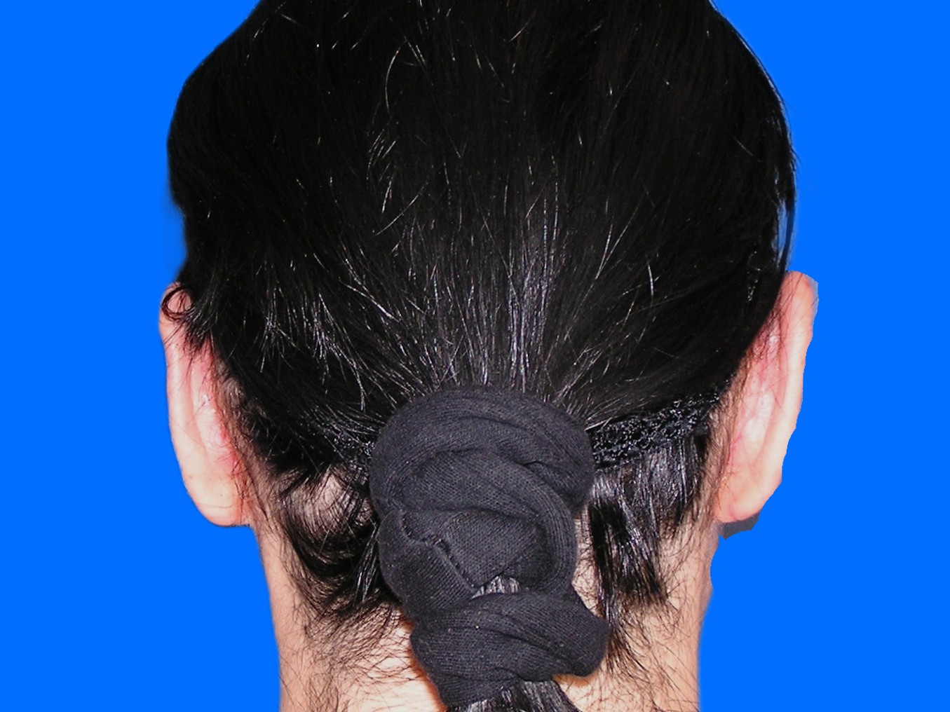 After Image: Patient Case #1137 - back