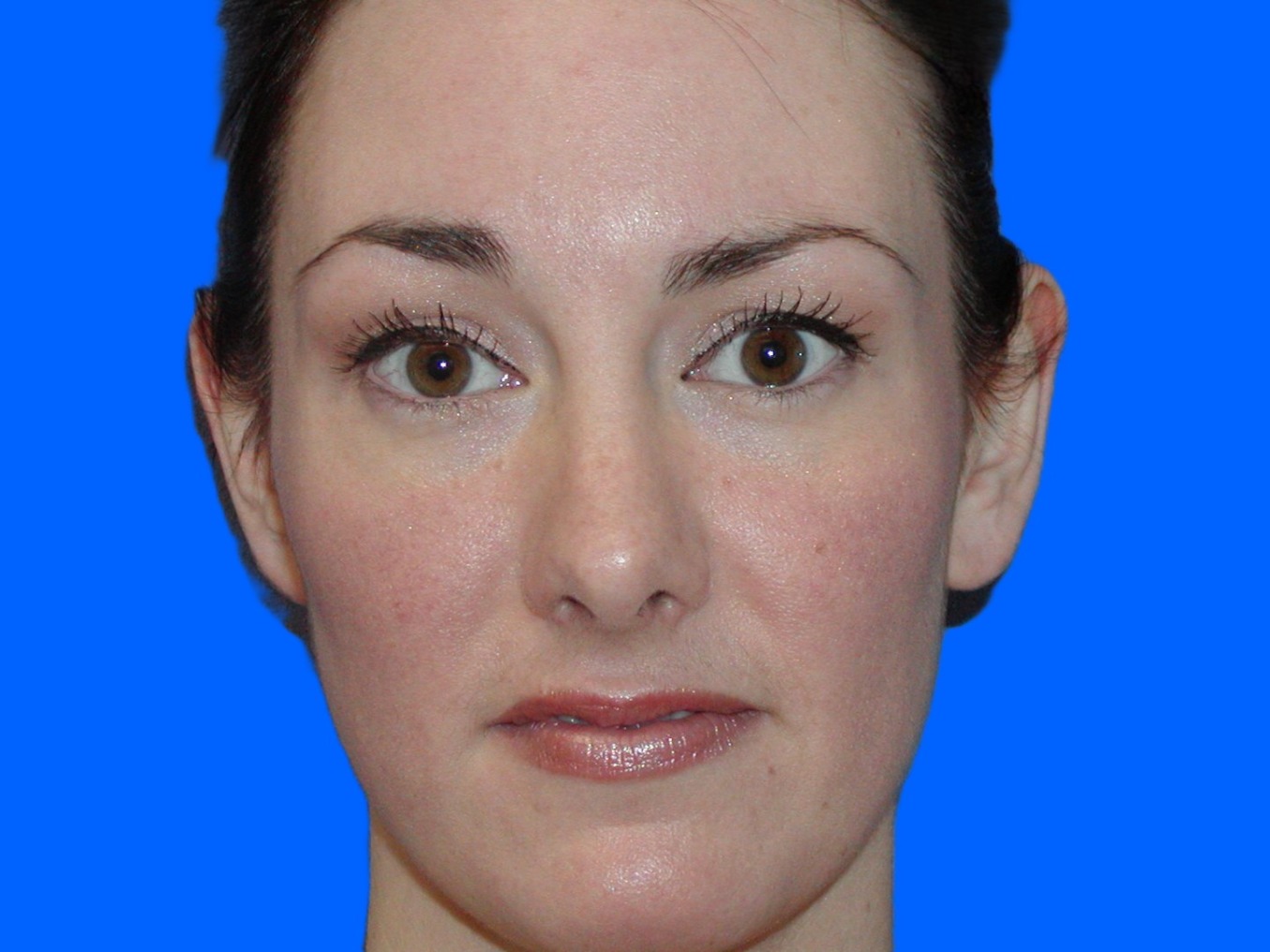 Before Image: Patient Case #1137 - front