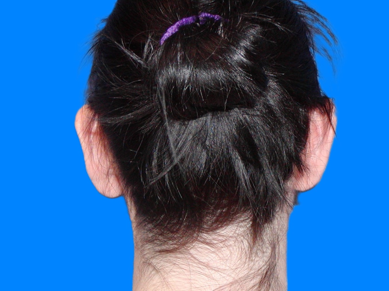 Before Image: Patient Case #1137 - back