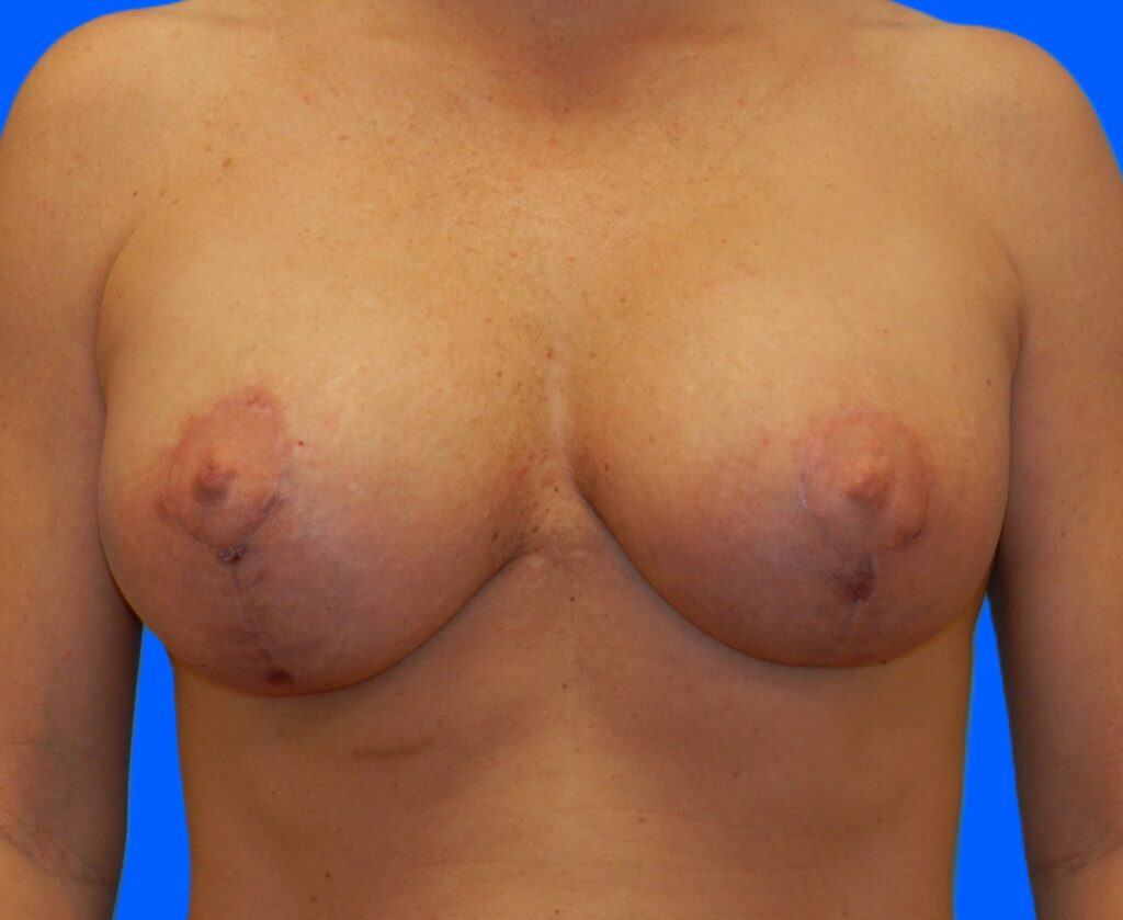 After Image: Patient Case #1147 - front