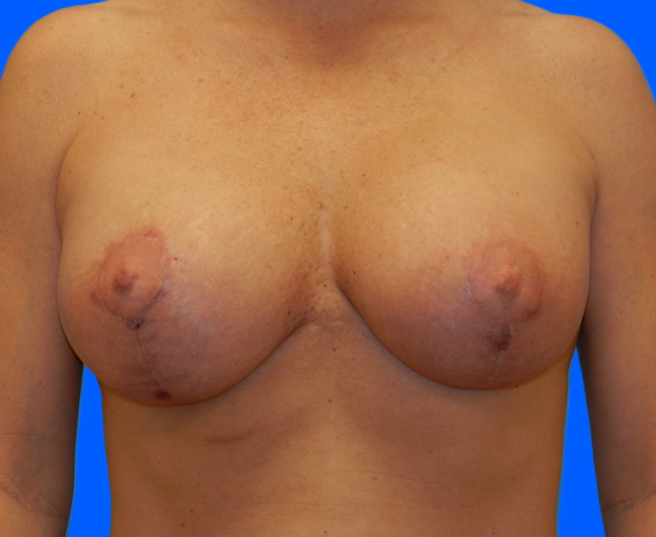 After Image: Patient Case #1147 - front