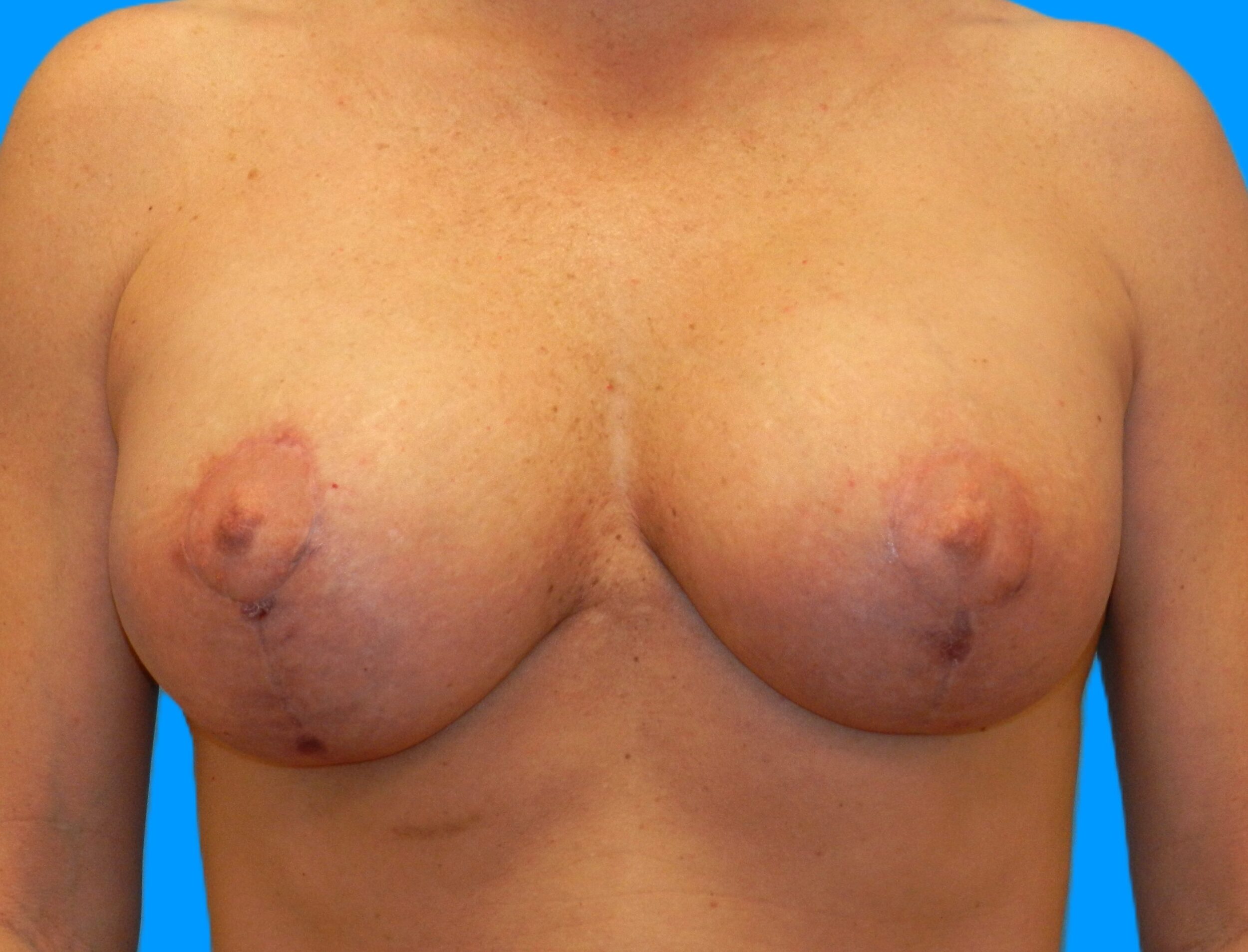 After Image: Patient Case #1147 - front