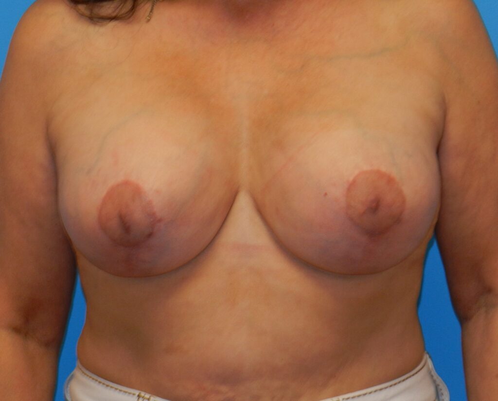 After Image: Patient Case #1149 - front