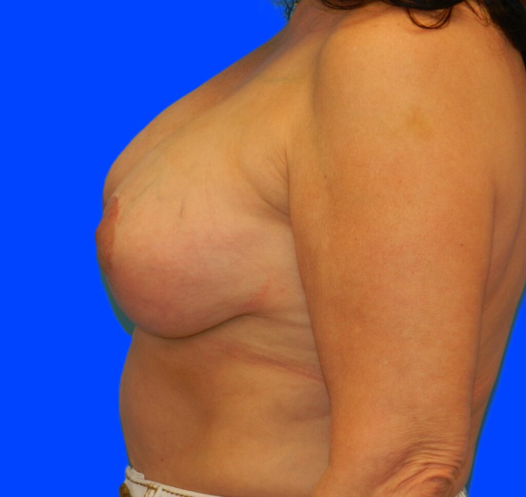 After Image: Patient Case #1149 - left-side