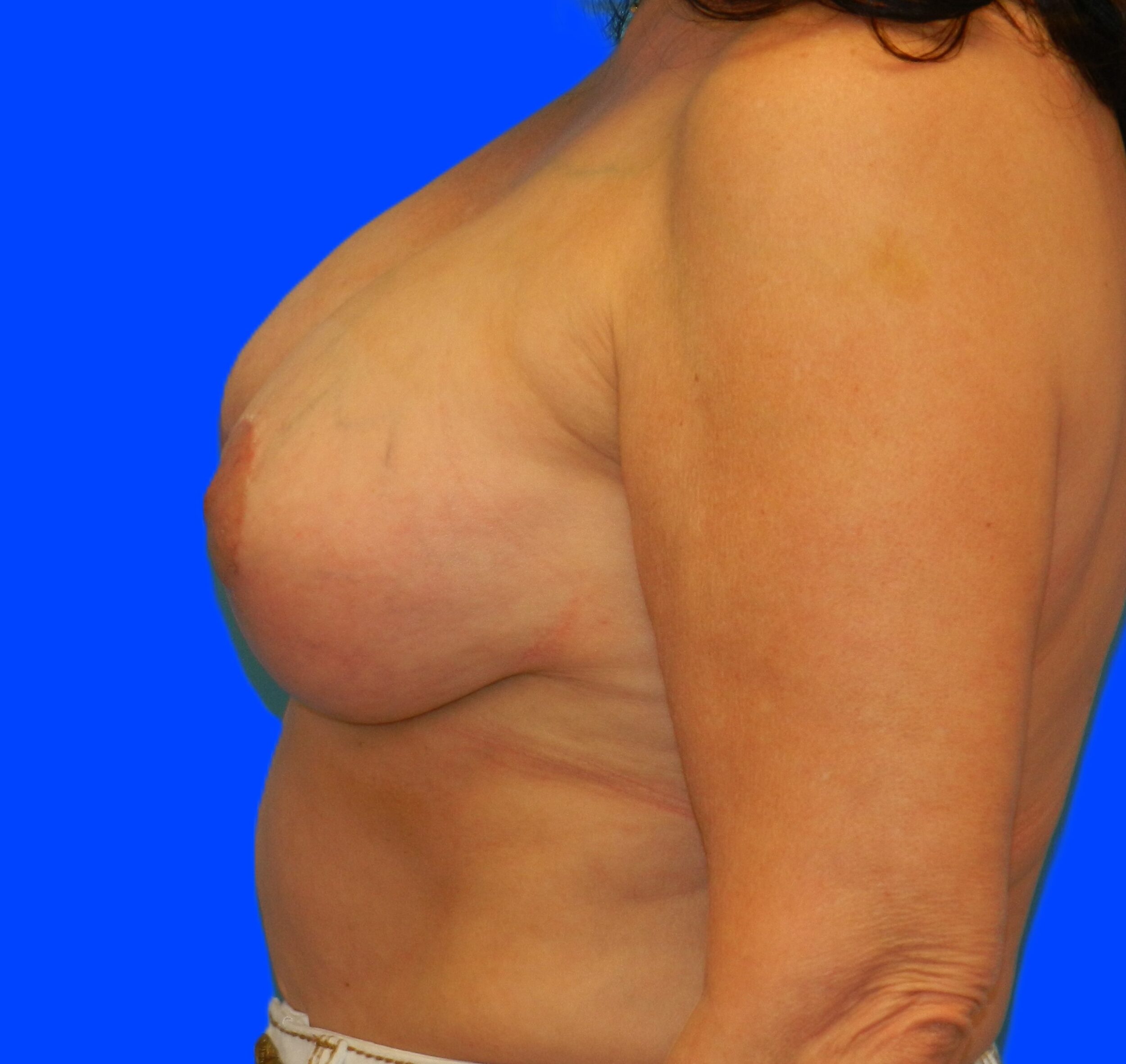 After Image: Patient Case #1149 - left-side