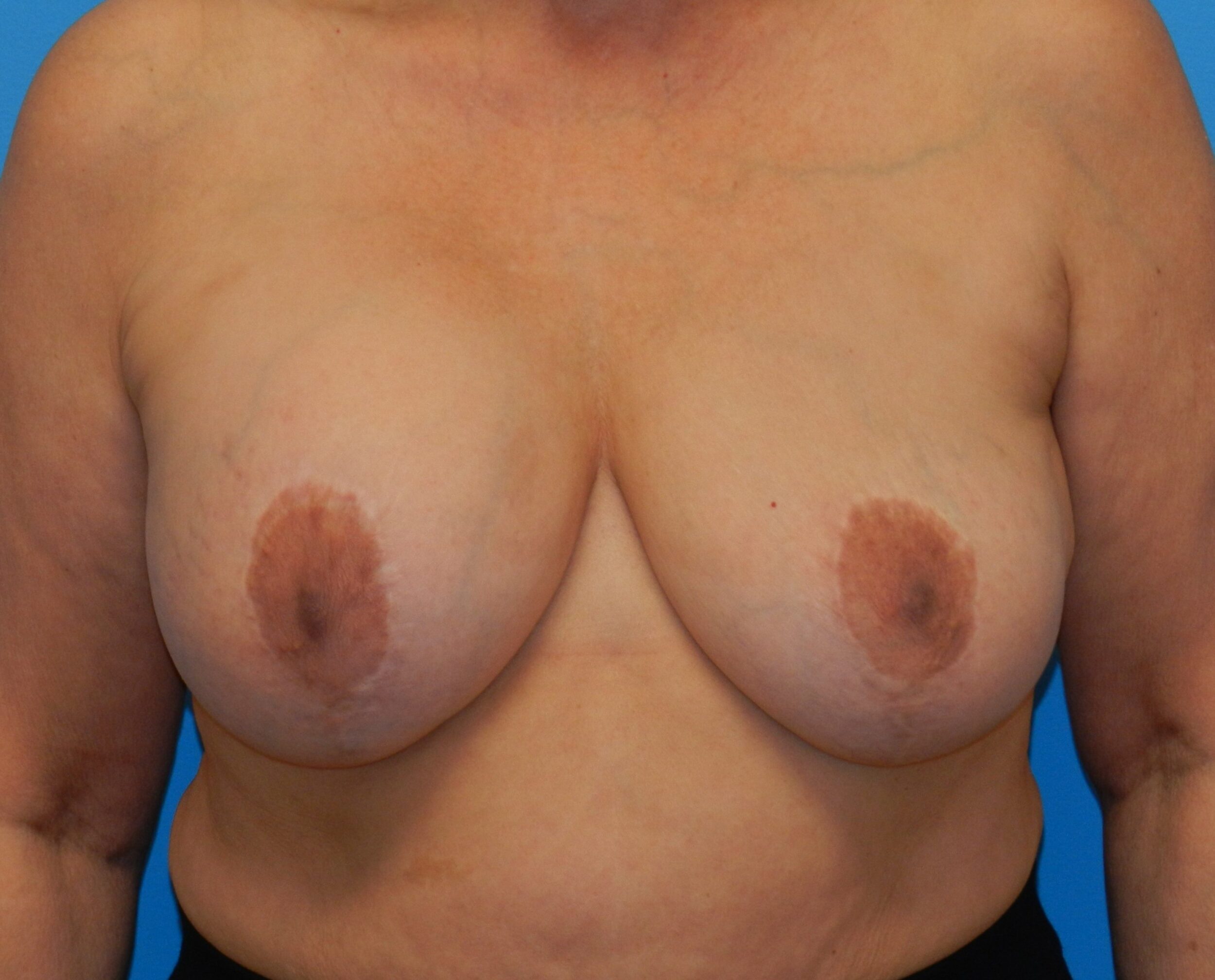 Before Image: Patient Case #1149 - front