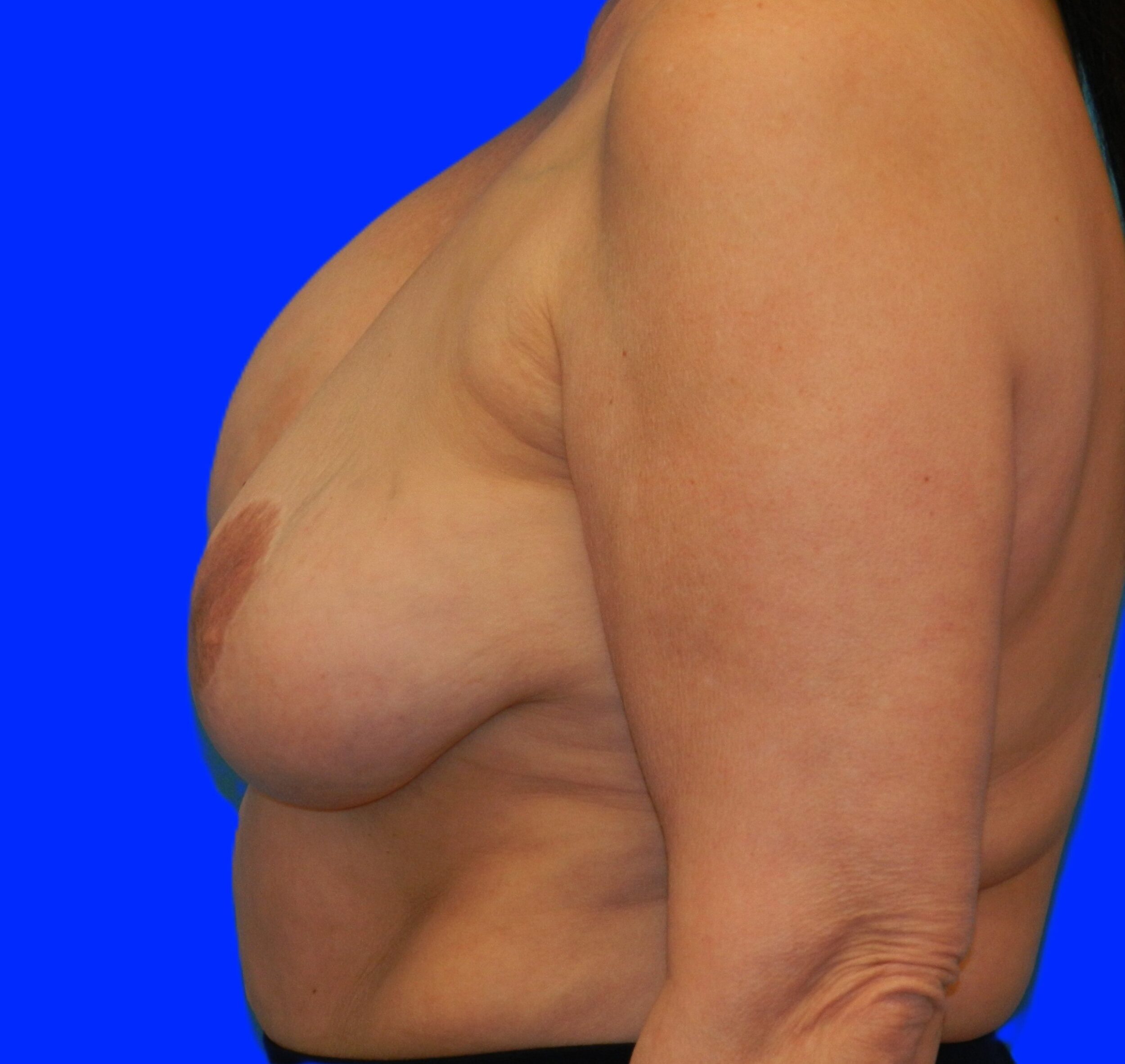 Before Image: Patient Case #1149 - left-side