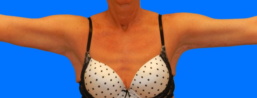 After Image: Patient Case #115 - front