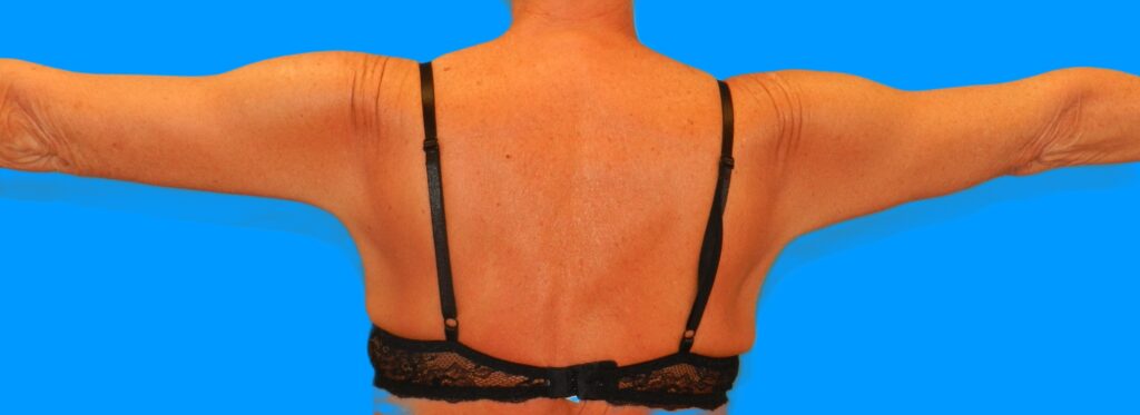 After Image: Patient Case #115 - back