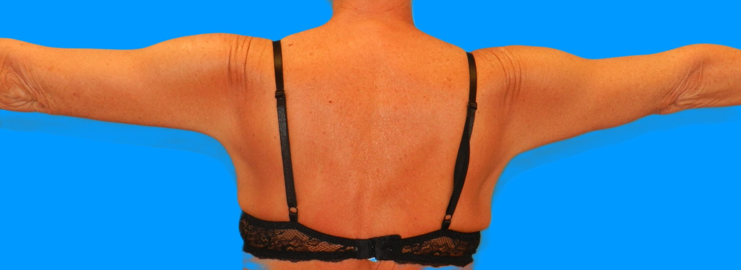 After Image: Patient Case #115 - back