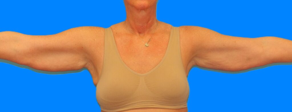 Before Image: Patient Case #115 - front