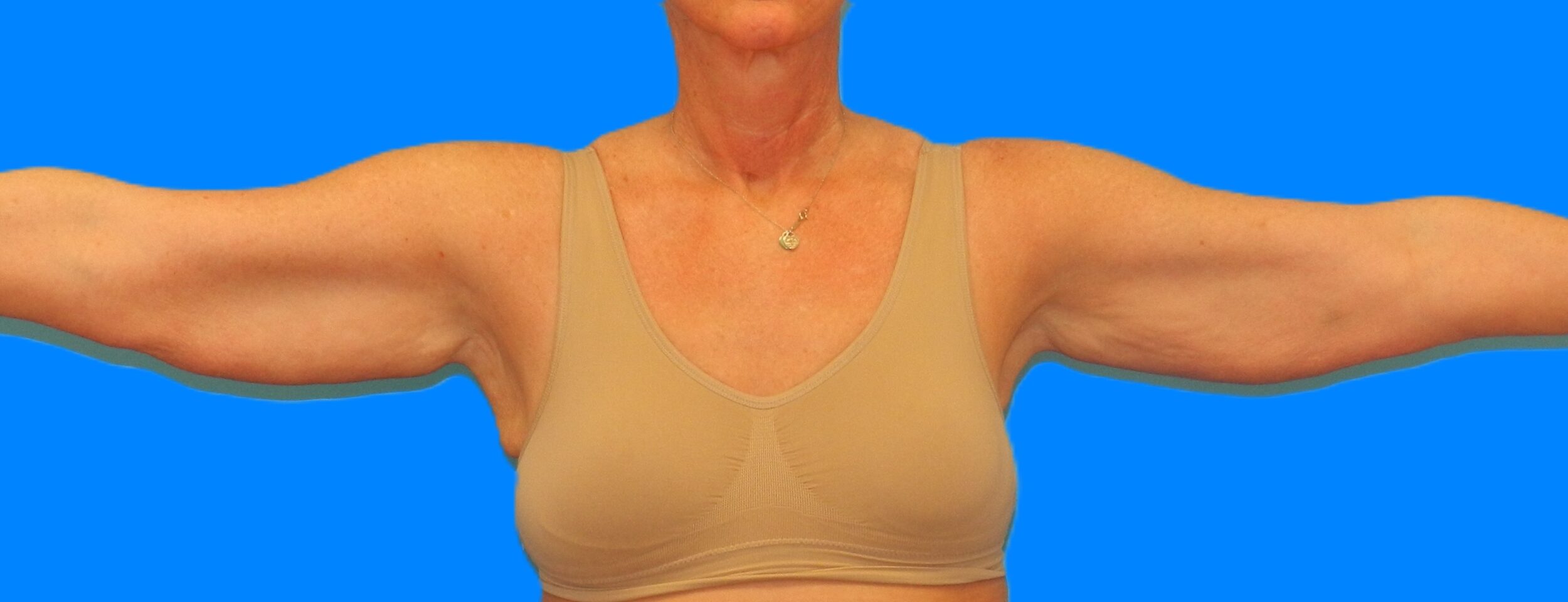 Before Image: Patient Case #115 - front