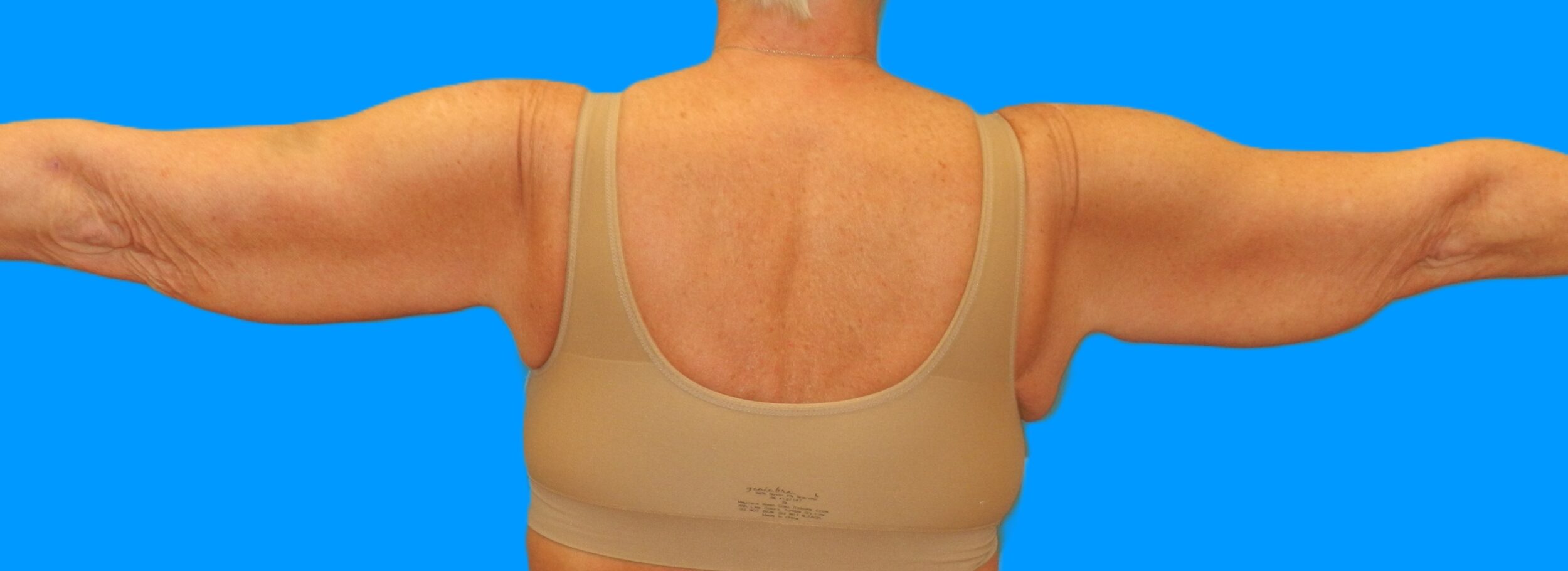 Before Image: Patient Case #115 - back
