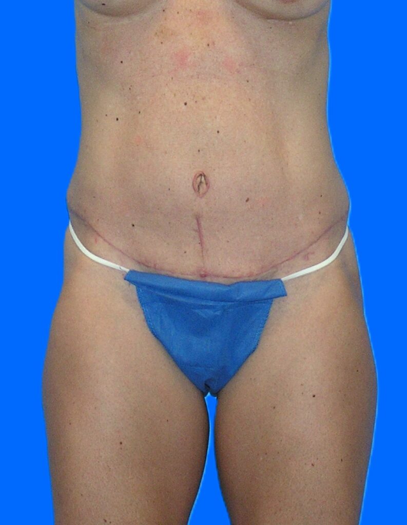After Image: Patient Case #1164 - front