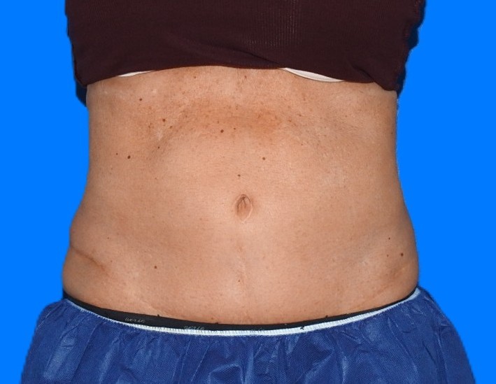 After Image: Patient Case #1164 - front