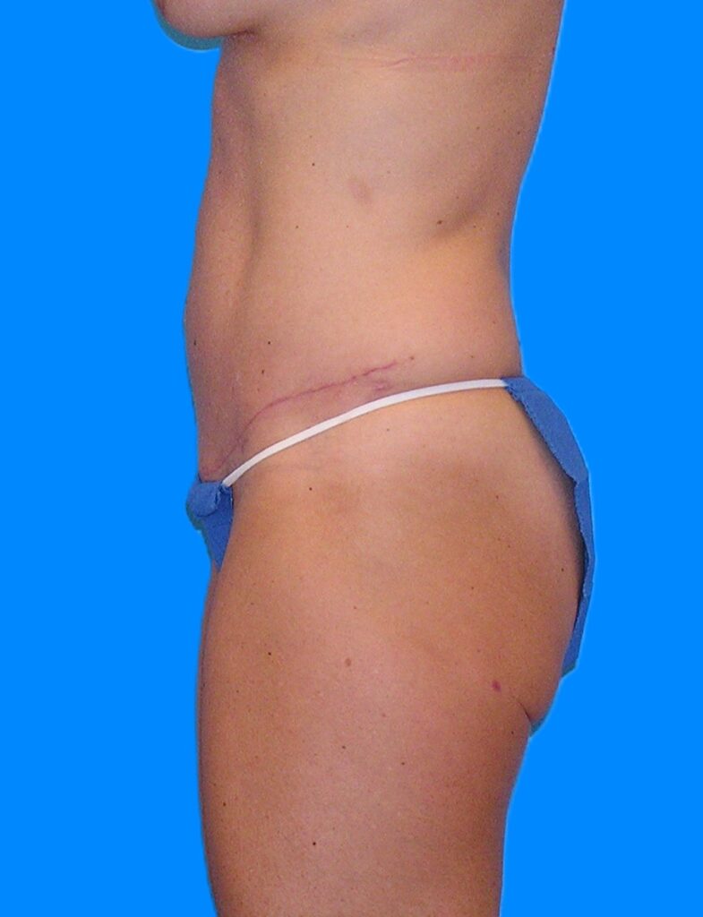 After Image: Patient Case #1164 - left-side