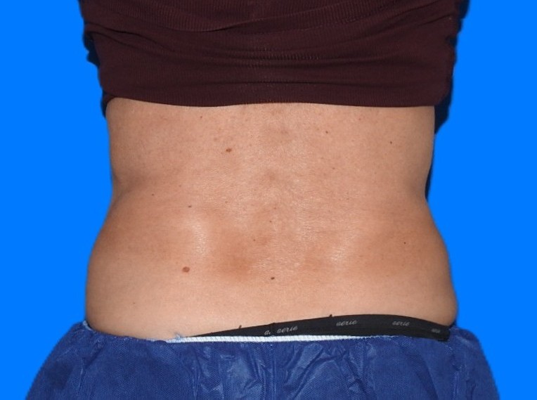 After Image: Patient Case #1164 - back