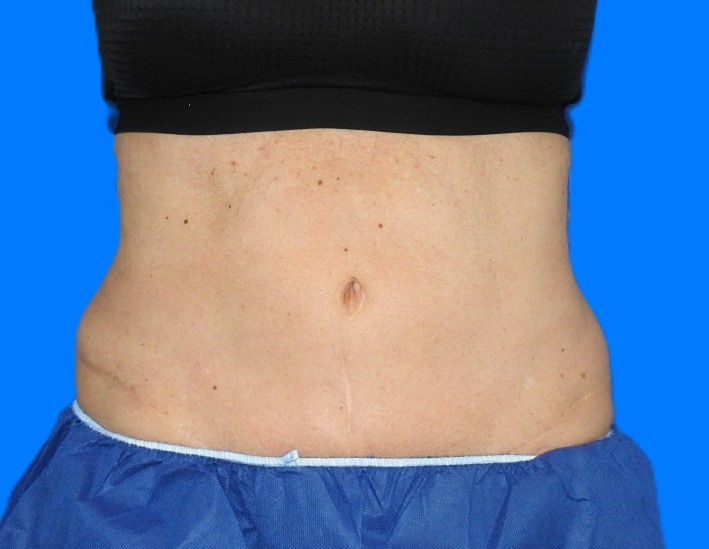 Before Image: Patient Case #1164 - front